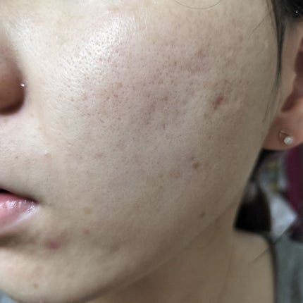 Azelaic Acid Suspension 10%/The Ordinary/美容液を使ったクチコミ(2枚目)