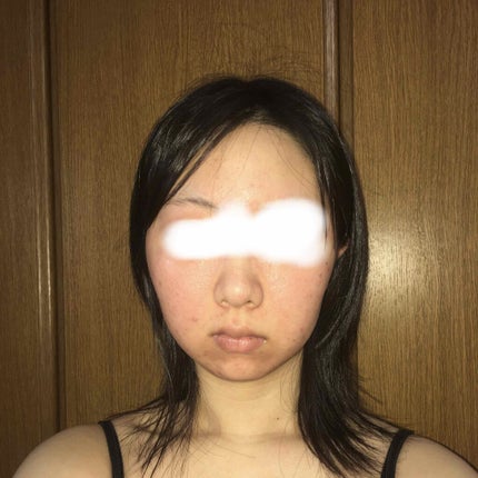 フワフワネコチャン on LIPS 「塗り始めて5日、6日目の朝の写真です。昨日は一日晴れも赤みも引..」(4枚目)