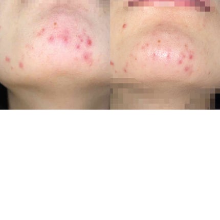 オキシドール(医薬品)/日本薬局方/その他を使ったクチコミ(3枚目)