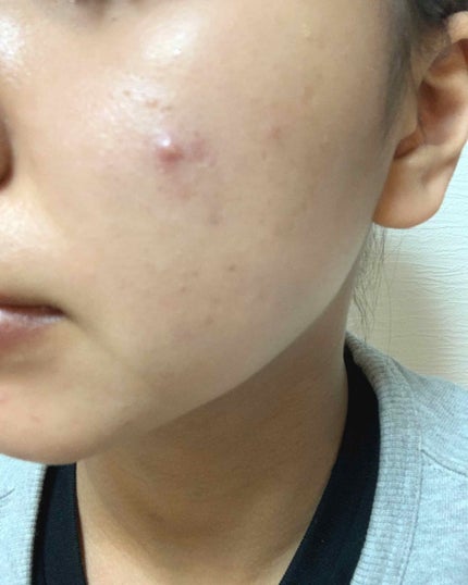 AC フェイスローション/NOV/化粧水を使ったクチコミ(2枚目)