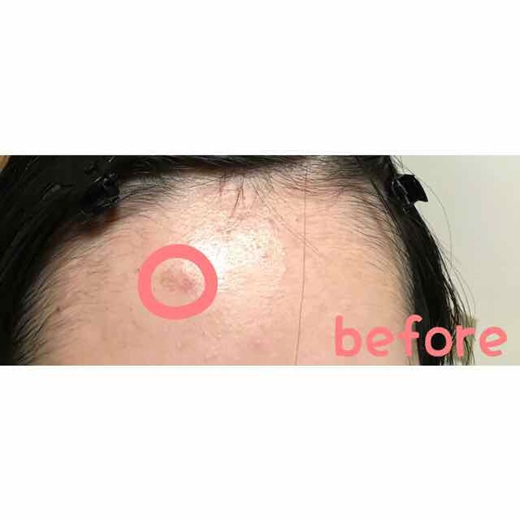 アットノンEX ジェル(医薬品)/アットノン/その他を使ったクチコミ(2枚目)