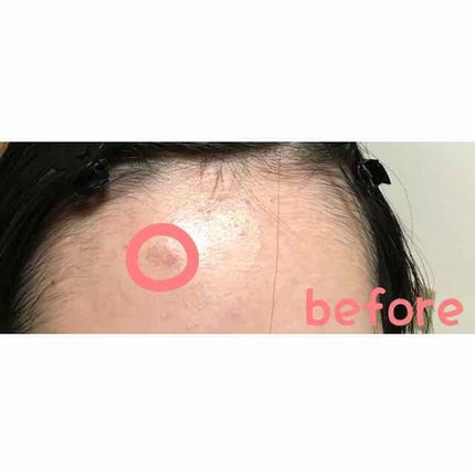 アットノンEX ジェル(医薬品)/アットノン/その他を使ったクチコミ(2枚目)