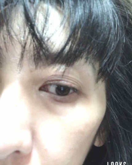 バイオイル/バイオイル/フェイスオイルを使ったクチコミ(2枚目)