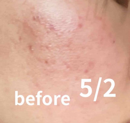 バイオイル/バイオイル/フェイスオイルを使ったクチコミ(2枚目)