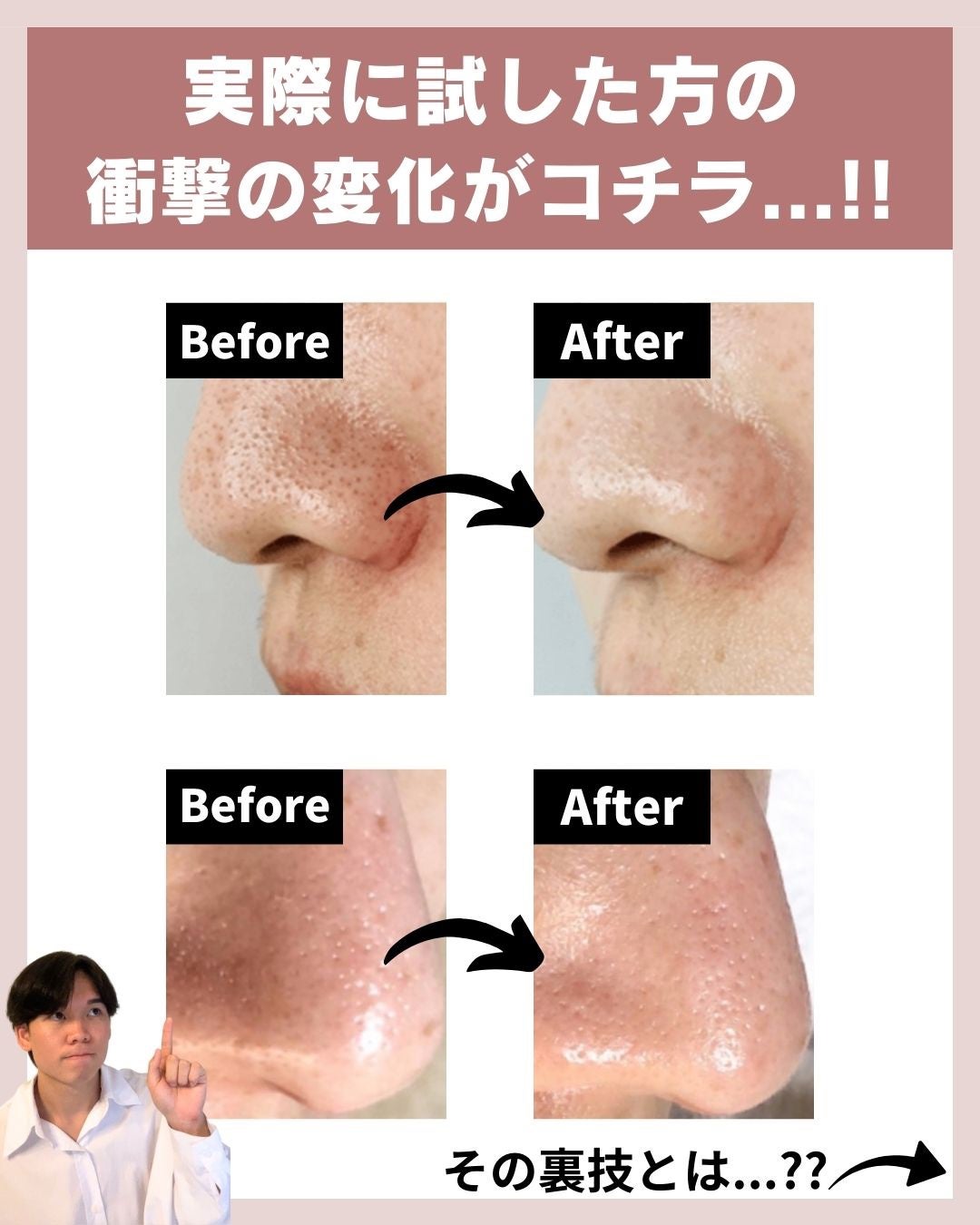 あなたの肌に合ったスキンケア💐コーくん先生 on LIPS 「【知らないとマジで損】エグいほど鼻の角栓が消える方法..あなた..」(7枚目)