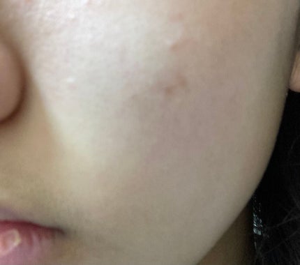 SORA on LIPS 「こんにちは!初投稿です!写真である通りなんか、白ニキビ(?)み..」(3枚目)