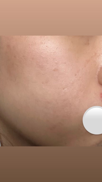 白潤プレミアム 薬用浸透美白乳液/肌ラボ/乳液を使ったクチコミ(6枚目)