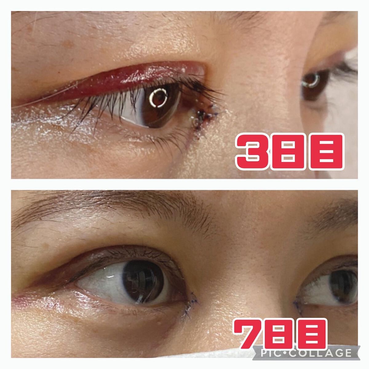 ふうせん @フォロバ100% on LIPS 「3月2日7日目写真で比べると違いがめっちゃわかる❣️❣️赤みは..」(3枚目)