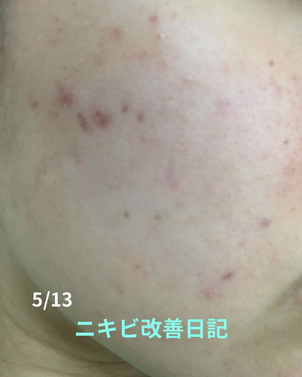 薬用 しみ 集中対策 美容液/メラノCC/美容液を使ったクチコミ（1枚目）