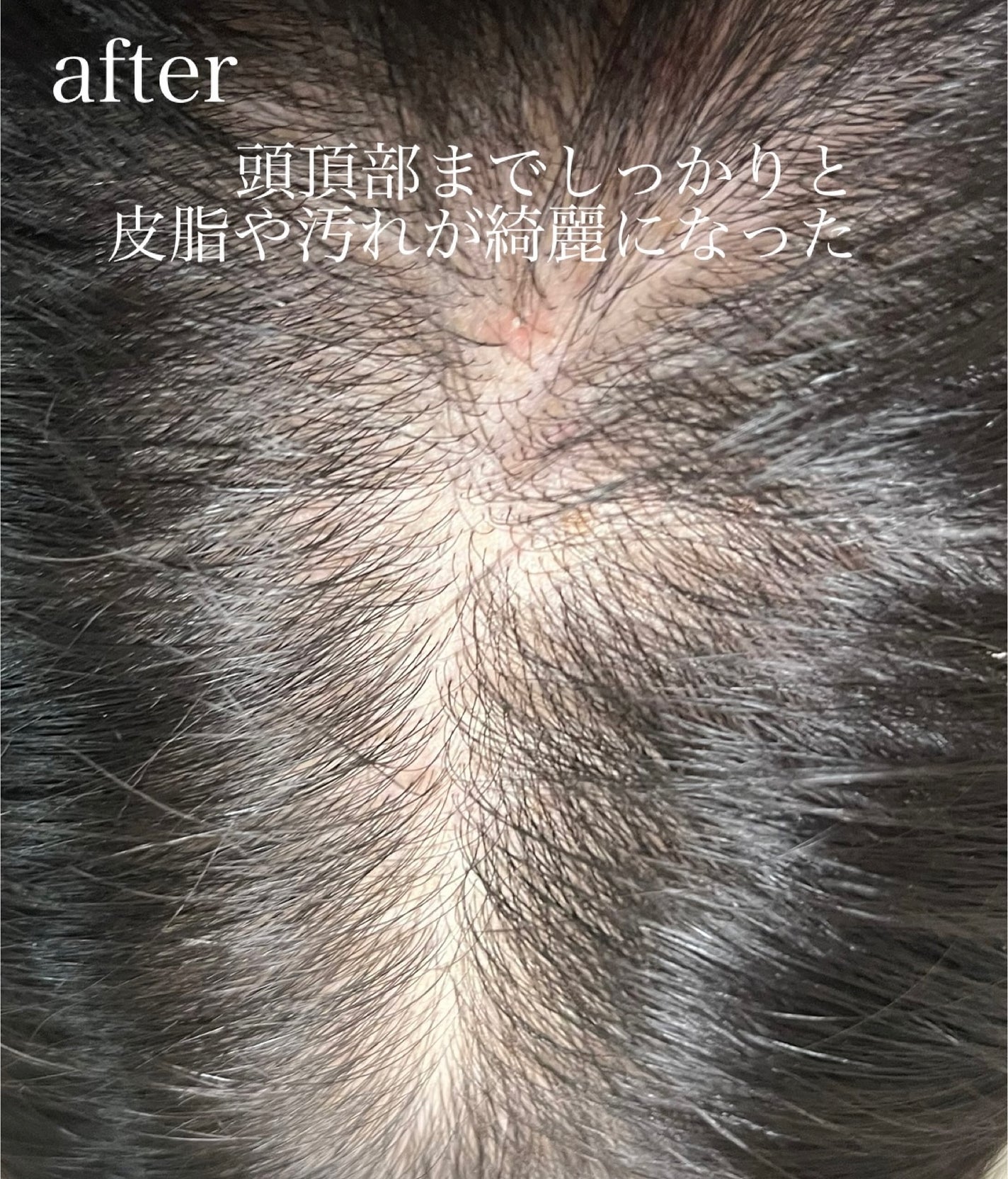 スパークリングスカルプスケーラー/ミンツリー/頭皮ケアを使ったクチコミ(4枚目)