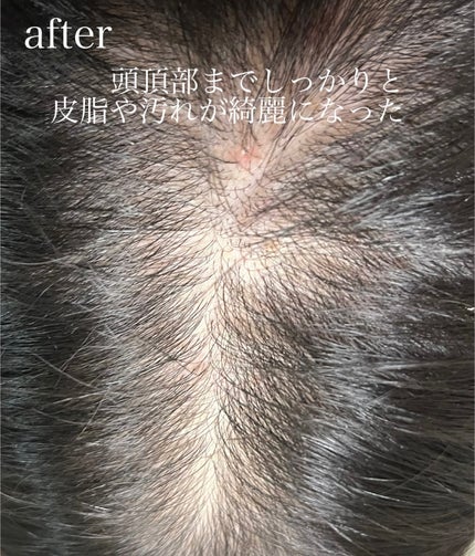 スパークリングスカルプスケーラー/ミンツリー/頭皮ケアを使ったクチコミ(4枚目)