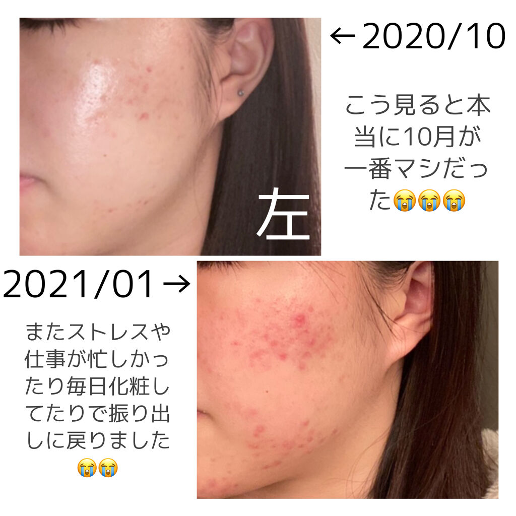 天使の優しさ/ラッシュ/その他洗顔料を使ったクチコミ（2枚目）