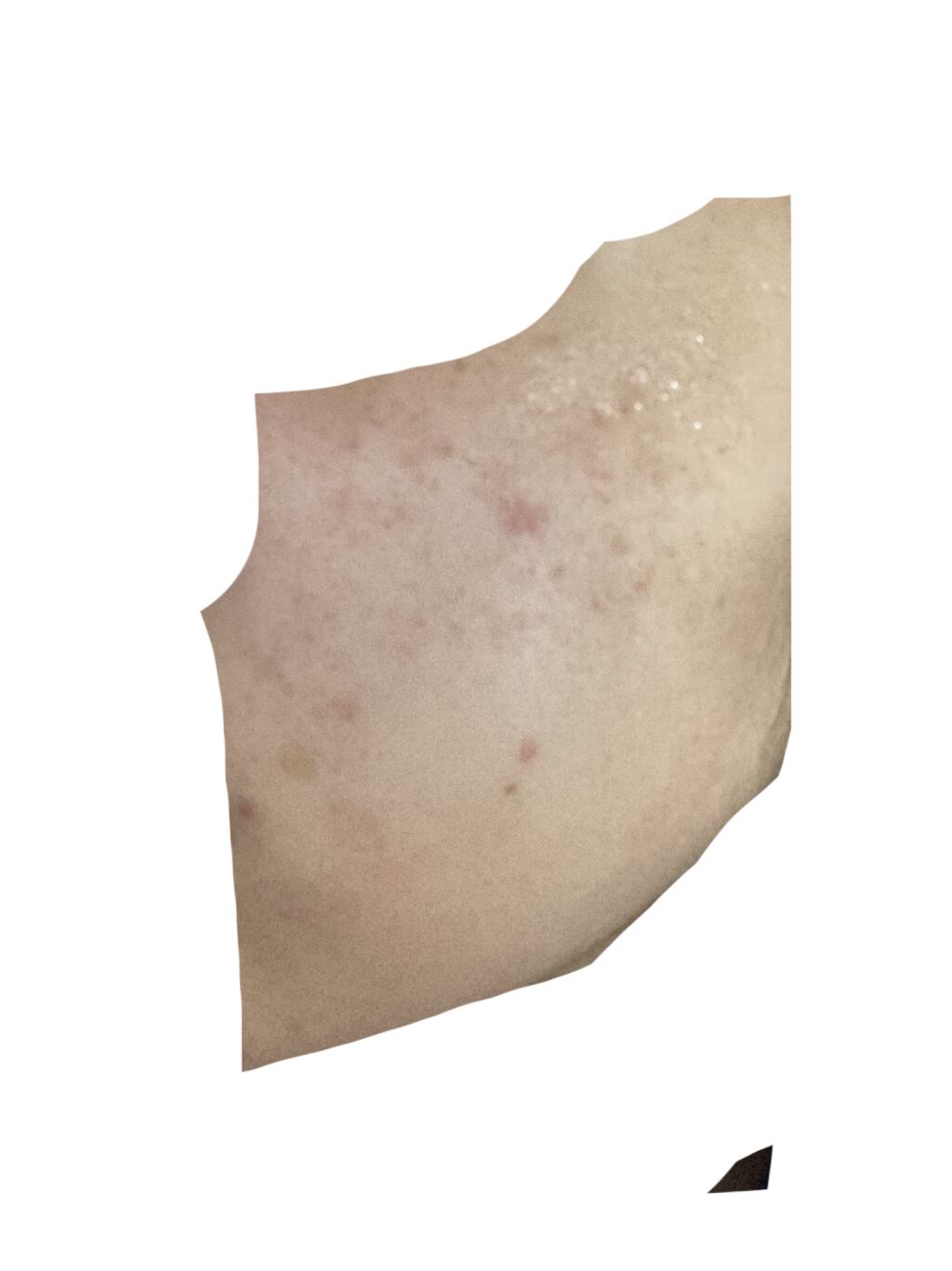 ベトネベートN軟膏AS(医薬品)/第一三共ヘルスケア/その他を使ったクチコミ（3枚目）