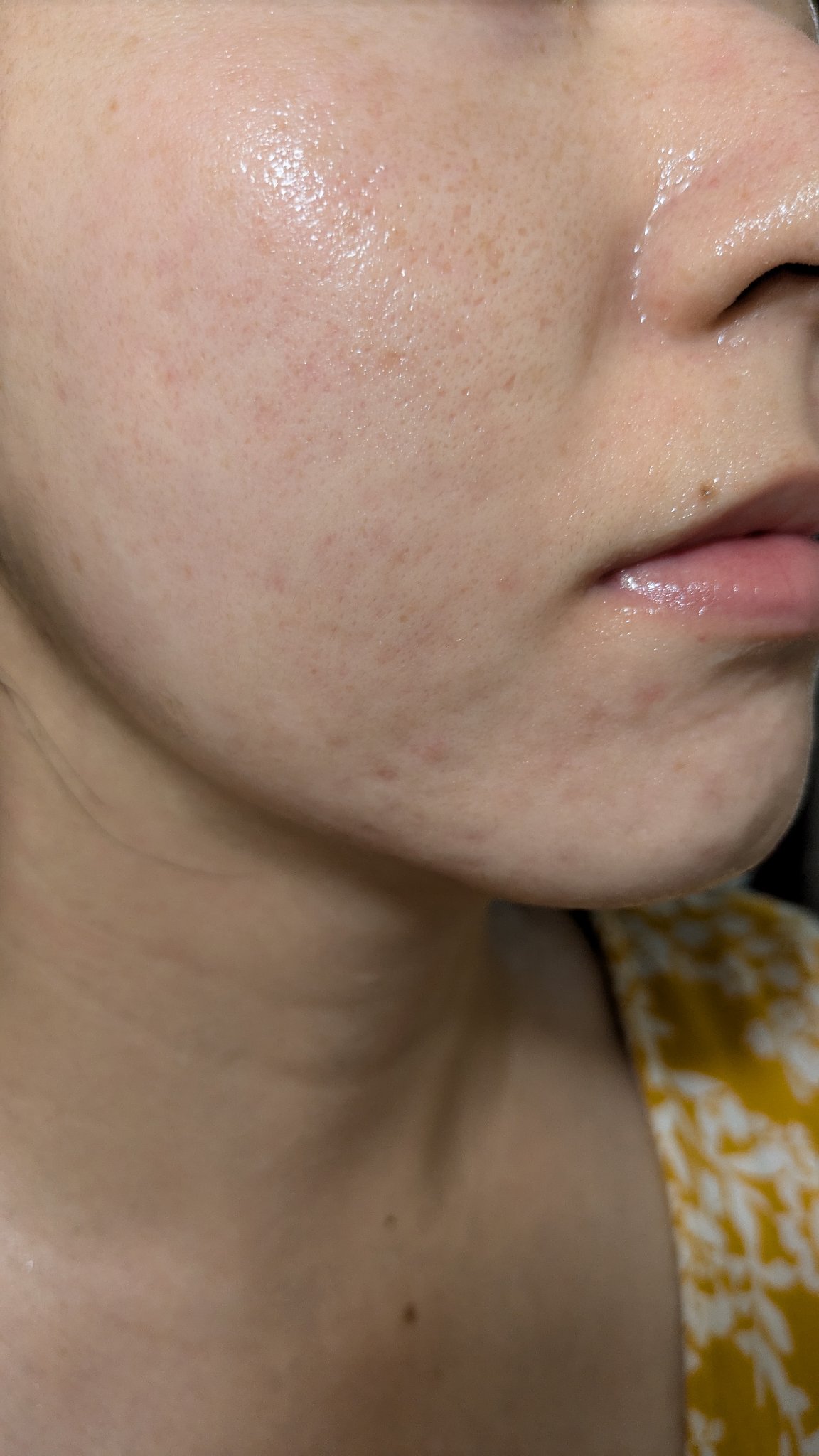 A2+NAG2ソリューション/The Ordinary/美容液を使ったクチコミ（1枚目）