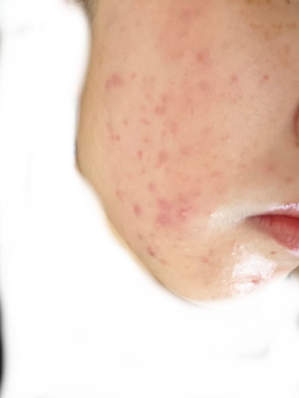 あめ on LIPS 「色々皮膚科でいただいた中でもこれがダントツで聞いてる気がする、..」(2枚目)