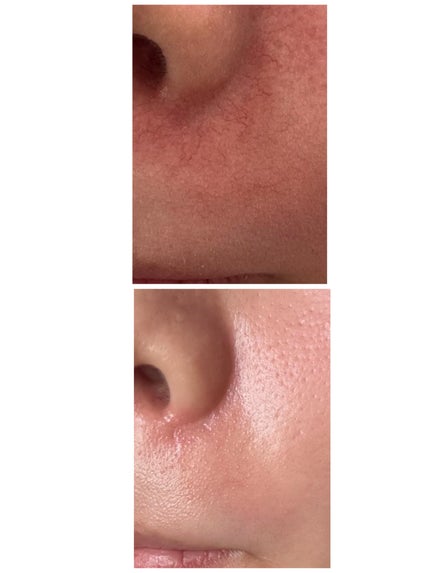 美容看護師ねこちゃん🐈💉 on LIPS 「小鼻の赤み、毛細血管に悩んでる方。この場で言うのも何ですが…申..」(1枚目)