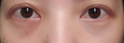 ラスティンコンシーラーペンシル/TIMAGE/ペンシルコンシーラーを使ったクチコミ(1枚目)