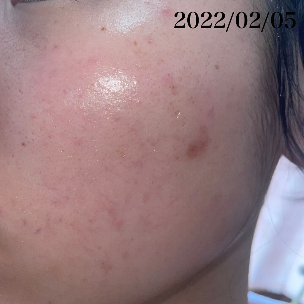 薬用しみ集中対策 プレミアム美容液/メラノCC/美容液を使ったクチコミ（3枚目）