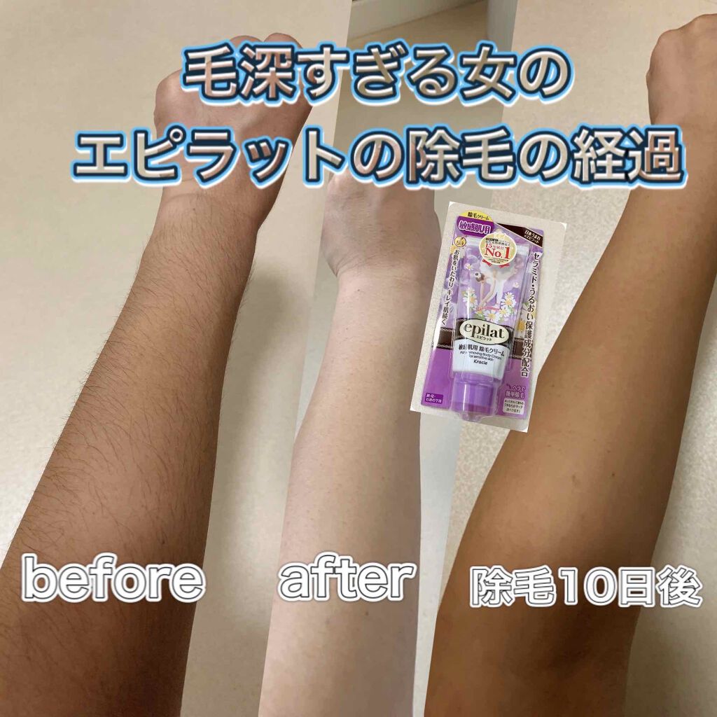 除毛クリームキット敏感肌用/エピラット/除毛クリームを使ったクチコミ(1枚目)