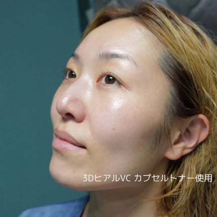 3DヒアルVC カプセルトナー/TARAJU/化粧水を使ったクチコミ(5枚目)
