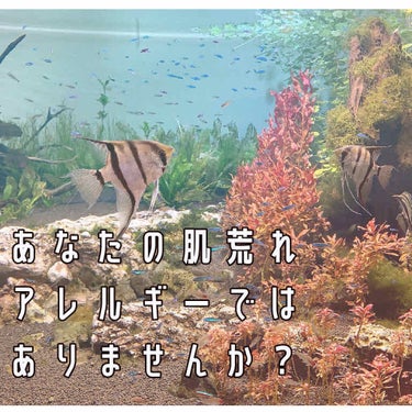 【再更新】
あなたの肌荒れ、本当にストレスや思春期によるものでしょうか…？

私が劇的にニキビ、肌荒れが治ったのは

①加齢→16歳頃から普通に肌が落ち着いてきました
②【アレルギー対策】
③現在：保湿