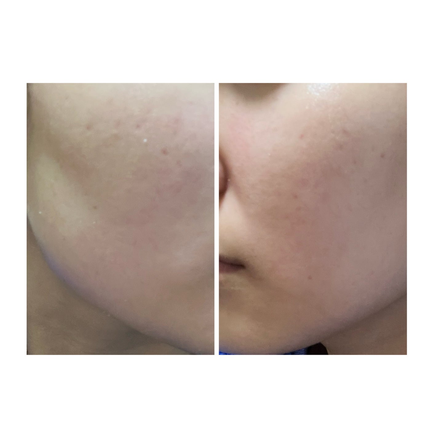 ぽむ on LIPS 「2023.9.13皮膚科に受診 エピデュオとヘパリン処方1枚目..」(2枚目)