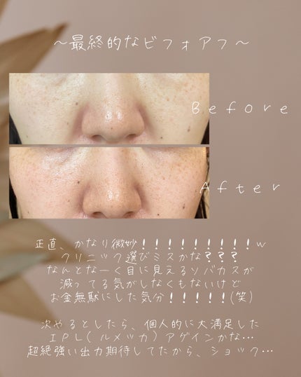 ããðª on LIPS ããã³ã¹ãããã®èšé²âïžðããããããã³ã¬ãŒã¶ãŒããšã¯ãã³ç§ïŒ1..ãïŒ5æç®ïŒ