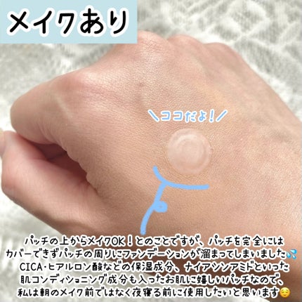 プロアクティブ スキンケアパッチ/プロアクティブ/にきびパッチを使ったクチコミ(5枚目)