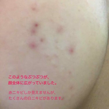 メンソレータム アクネス 薬用クリーム洗顔のクチコミ「二三枚目は私の写真なので注意です！
画像を保存するのは辞めてください🙇‍♀️🙇‍♀️🙇‍♀️
.....」（2枚目）