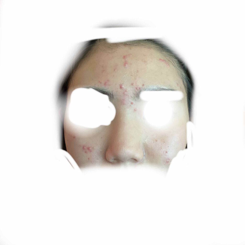 fabulous_perfume_1oau on LIPS 「高校2年生助けてください。どうしたらニキビ治りますか??今、デ..」(1枚目)