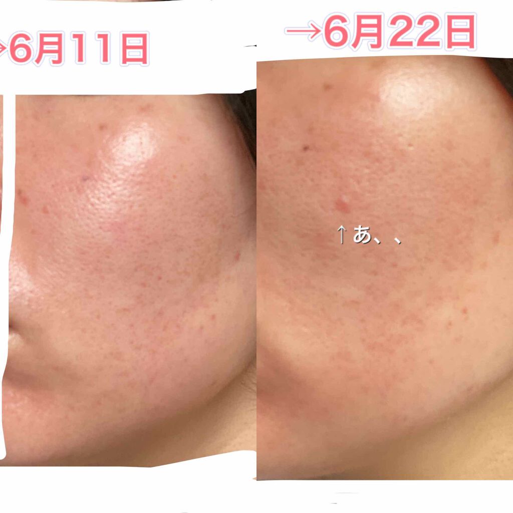 ベピオゲル/マルホ株式会社/その他を使ったクチコミ（3枚目）