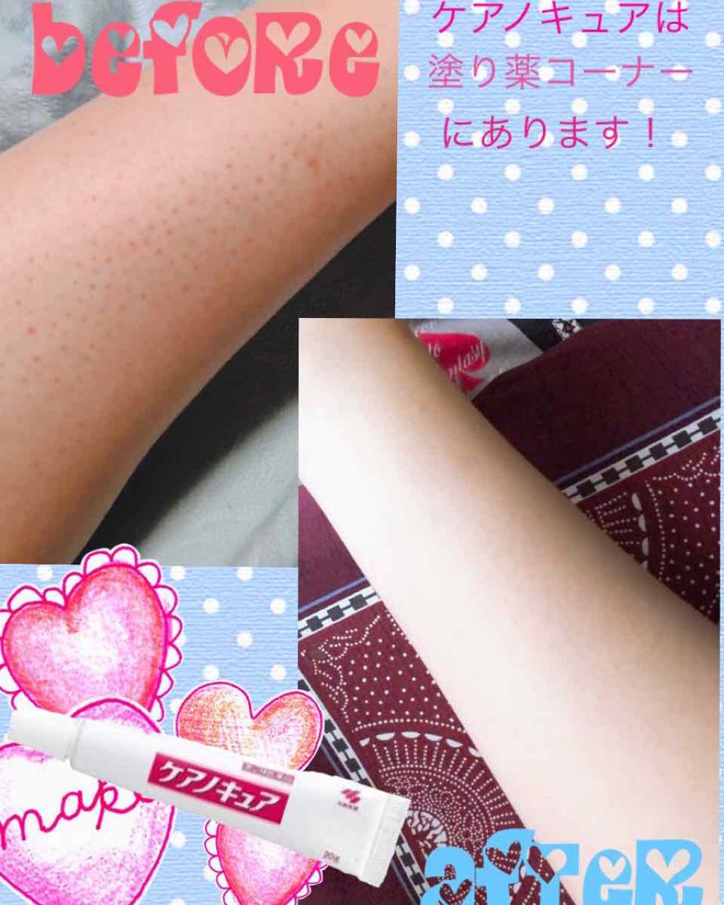 ケアノキュア(医薬品)/小林製薬/その他を使ったクチコミ(4枚目)