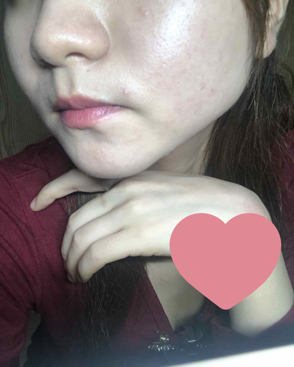 ペアアクネクリームW(医薬品)/ペア/その他を使ったクチコミ（2枚目）