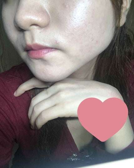 ペアアクネクリームW(医薬品)/ペア/その他を使ったクチコミ(2枚目)