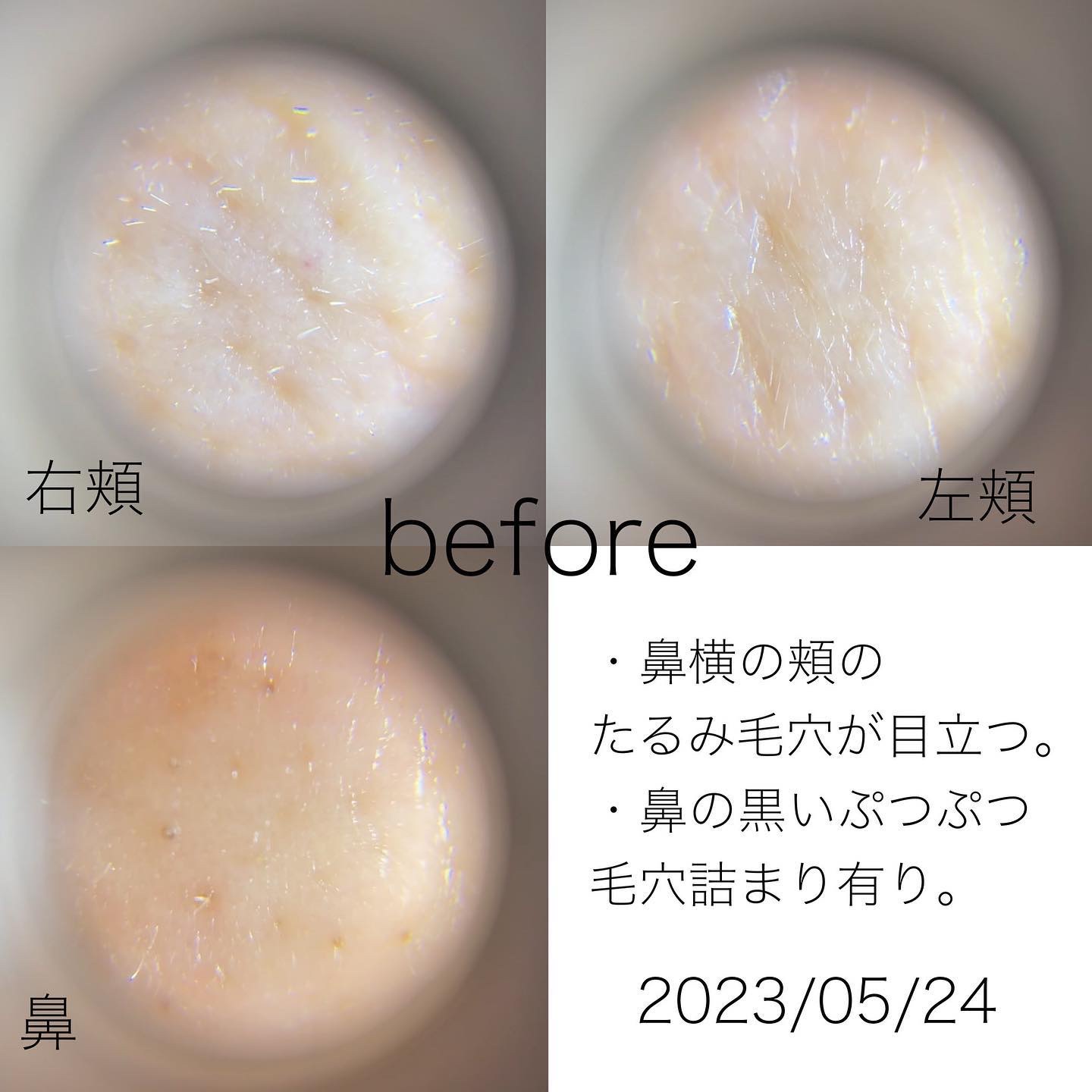 シカレチA クリーム0.05/VT/フェイスクリームを使ったクチコミ（3枚目）