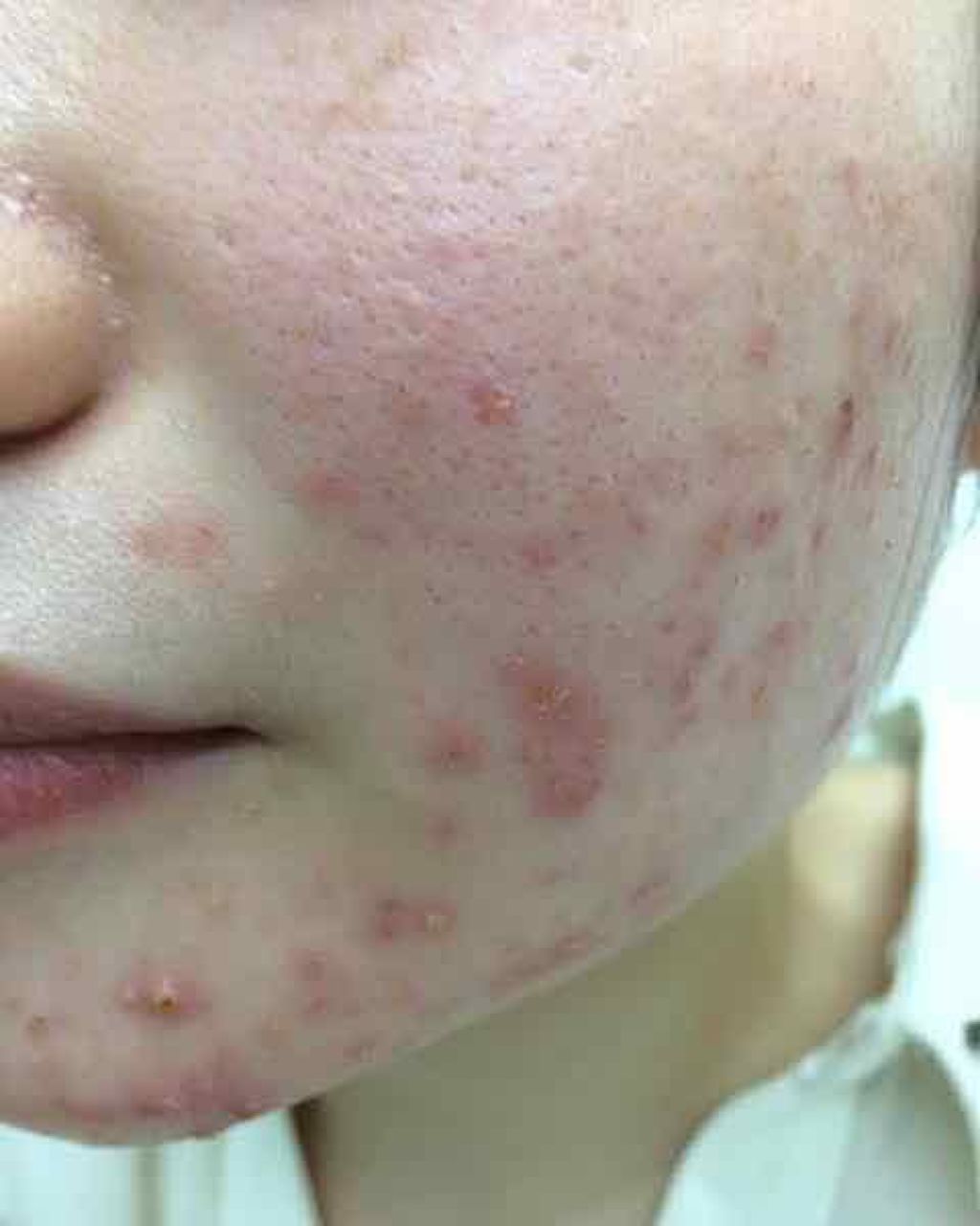 オードムーゲ 薬用ローション（ふきとり化粧水）/オードムーゲ/拭き取り化粧水を使ったクチコミ（2枚目）