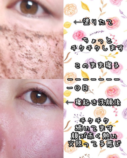 ダーマスキンピーリング/BQCELL/その他キットセットを使ったクチコミ(2枚目)