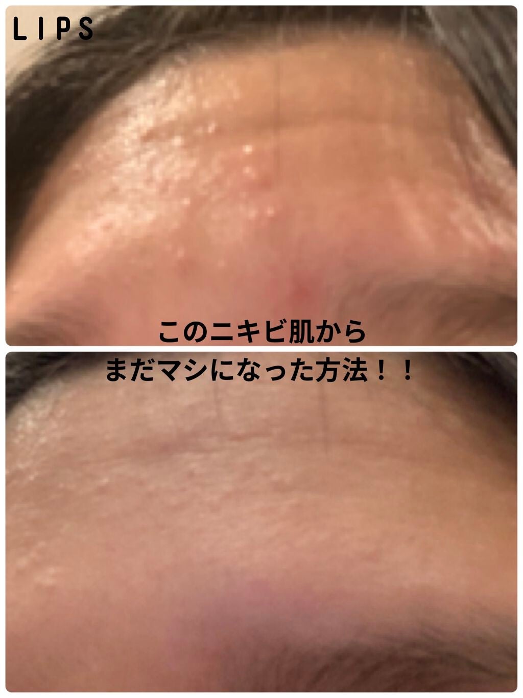 オードムーゲ 薬用ローション(ふきとり化粧水)/オードムーゲ/拭き取り化粧水を使ったクチコミ(1枚目)