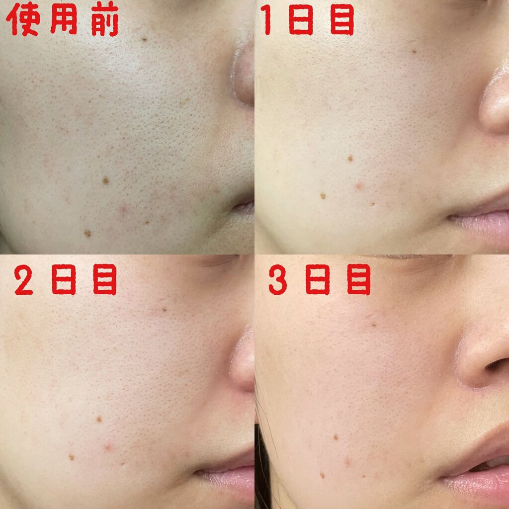 ポアタイトニングアンプルセラム/One-day's you/美容液を使ったクチコミ(5枚目)