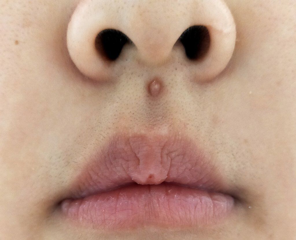 オロナインＨ軟膏 (医薬品)/オロナイン/その他を使ったクチコミ（3枚目）