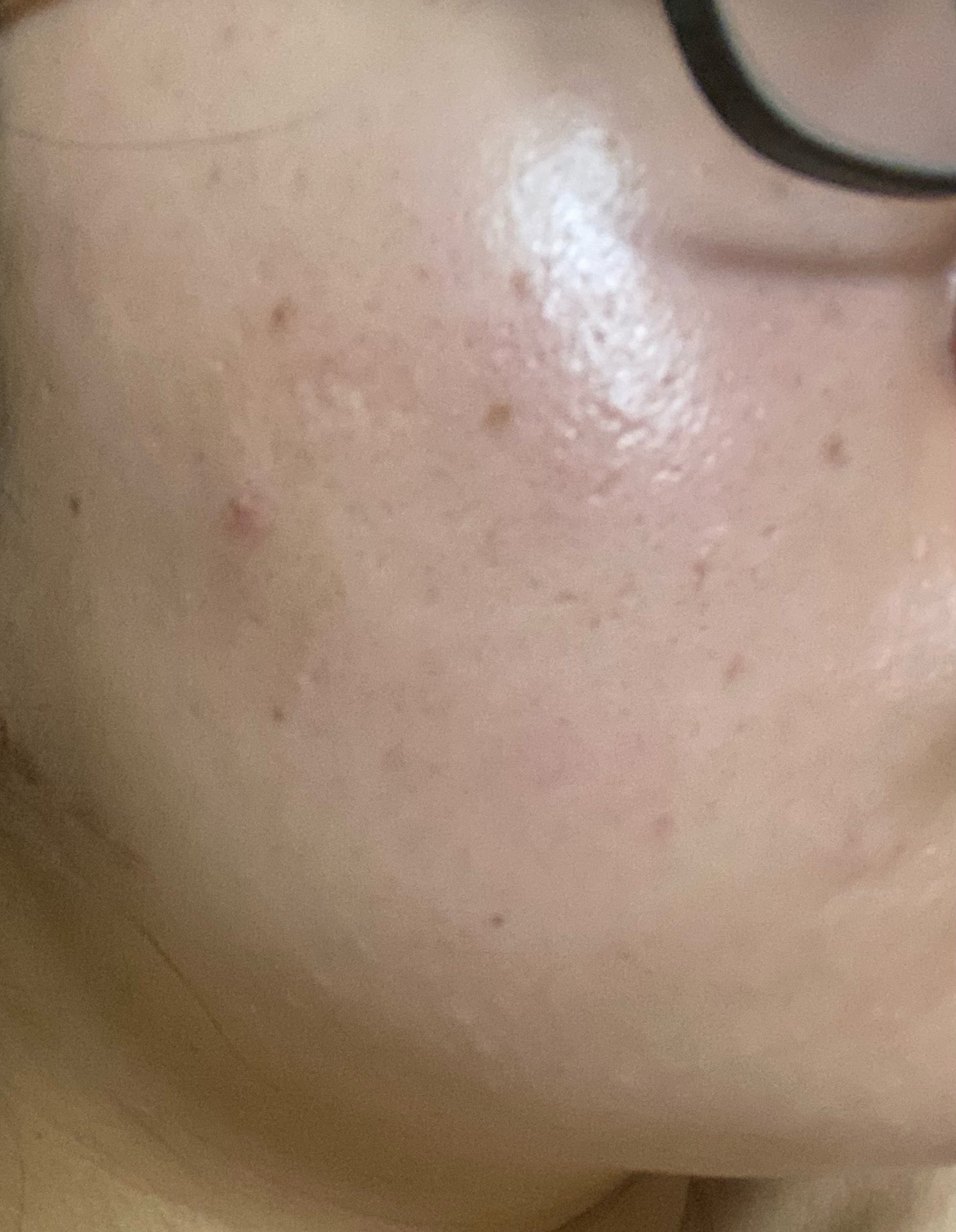 あられ on LIPS 「ダーマペン勢いで予約しちゃったんだけど6回やってもそんなに目に..」(3枚目)