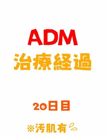 

【20日目】
17日目にはかさぶた取れてたのですが、
噂に聞いていた「ピンクの肌」が現れることなく、
不安MAXで過ごしています🤦‍♀️

写真じゃ全然分からないんですが、少しピンクいところはあるん