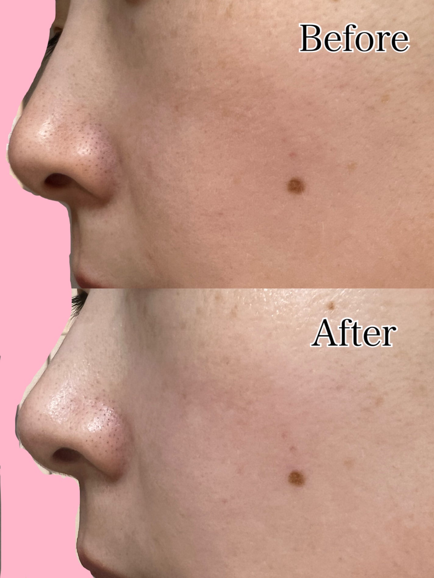 トーンブライトニング カプセルアンプル/SKIN1004/美容液を使ったクチコミ(2枚目)