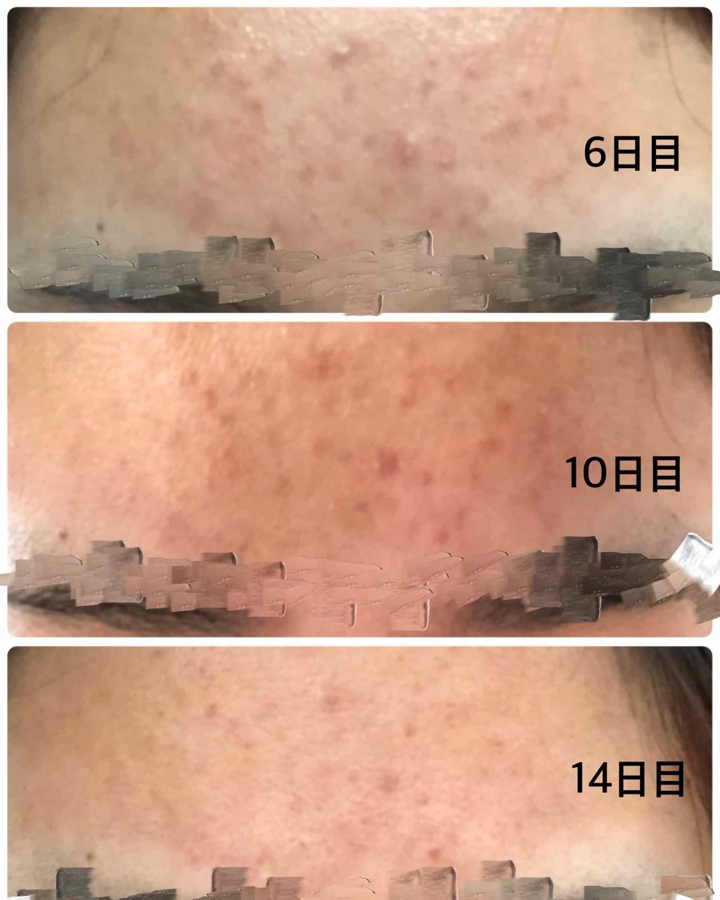 オードムーゲ 薬用ローション(ふきとり化粧水)/オードムーゲ/拭き取り化粧水を使ったクチコミ(3枚目)