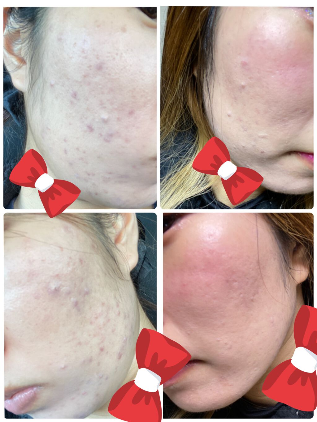 AKちゃん on LIPS 「ノーマルカメラで撮っています。ニキビが次から次へと増え止まりま..」(1枚目)