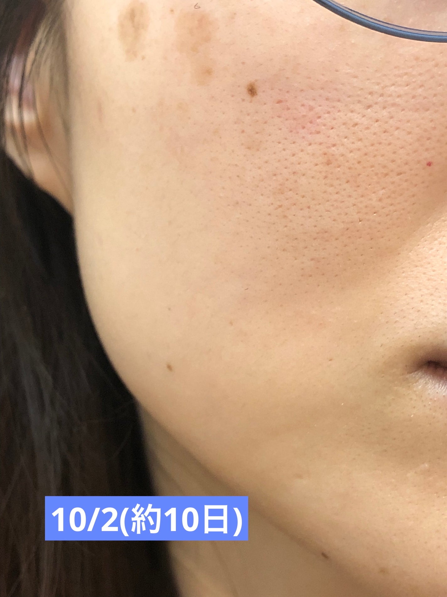 スキンライトセラピーII/Makeon/美顔器・マッサージを使ったクチコミ(4枚目)