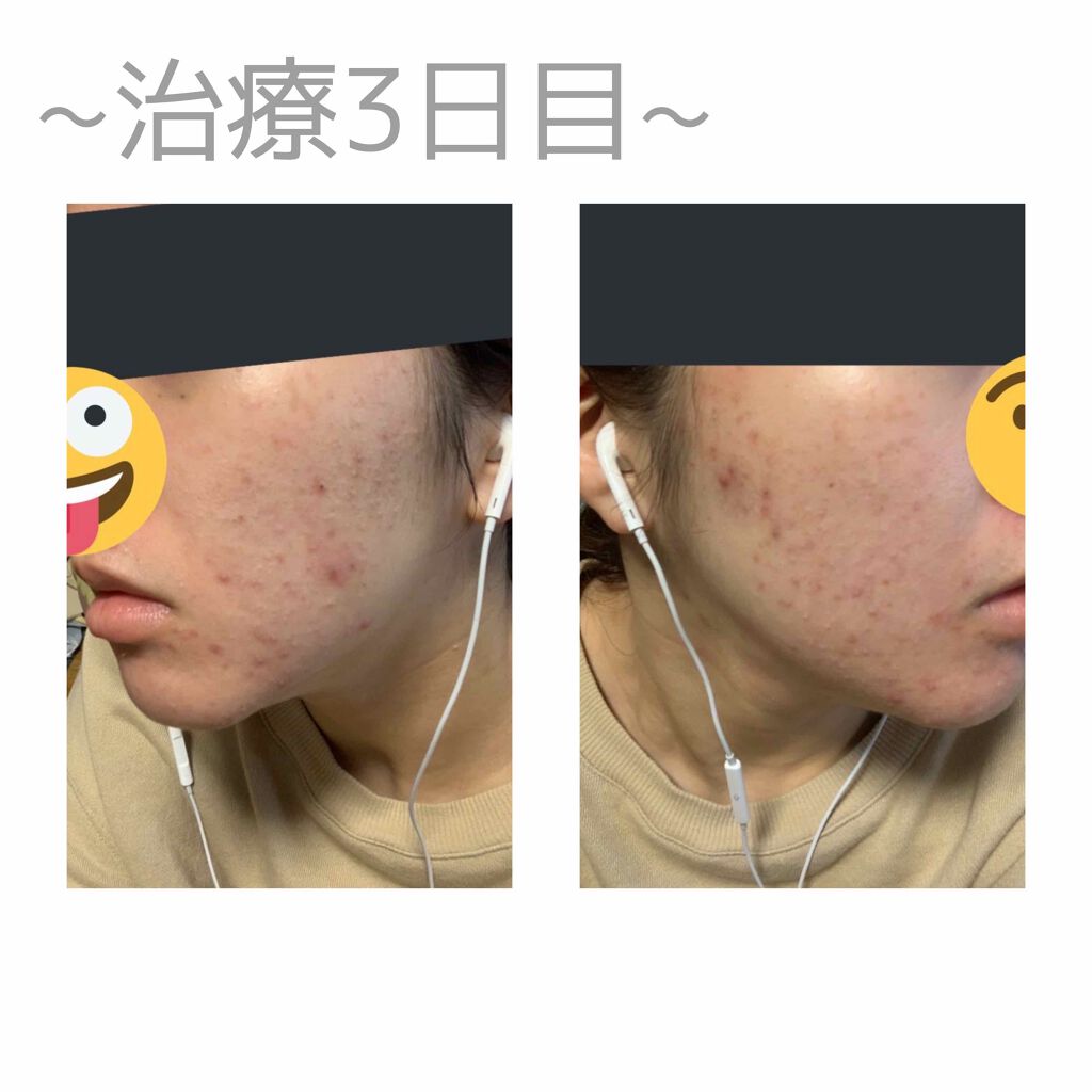 ビーソフテン ローション(医薬品)/持田製薬/その他を使ったクチコミ（2枚目）