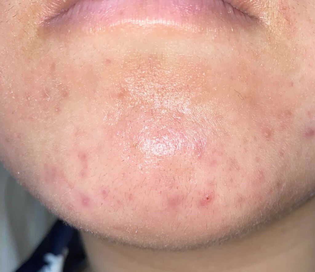 ぴろ on LIPS 「ニキビ撲滅日記10日目🔥6/3ついに十日目突入!!!!引き続き..」(4枚目)