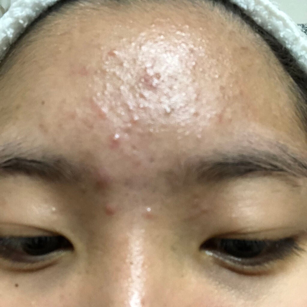 肌荒れとおさらば on LIPS 「17日目です🤍🤍頬のニキビがい収まってきたところで、ますますお..」(3枚目)