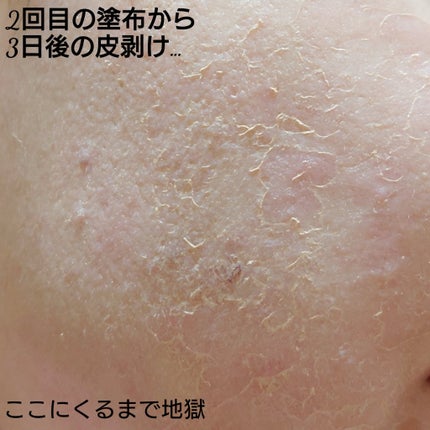 レチノールA 1% アドバンスドリバイタリゼーションクリーム/Life-flo/フェイスクリームを使ったクチコミ(4枚目)